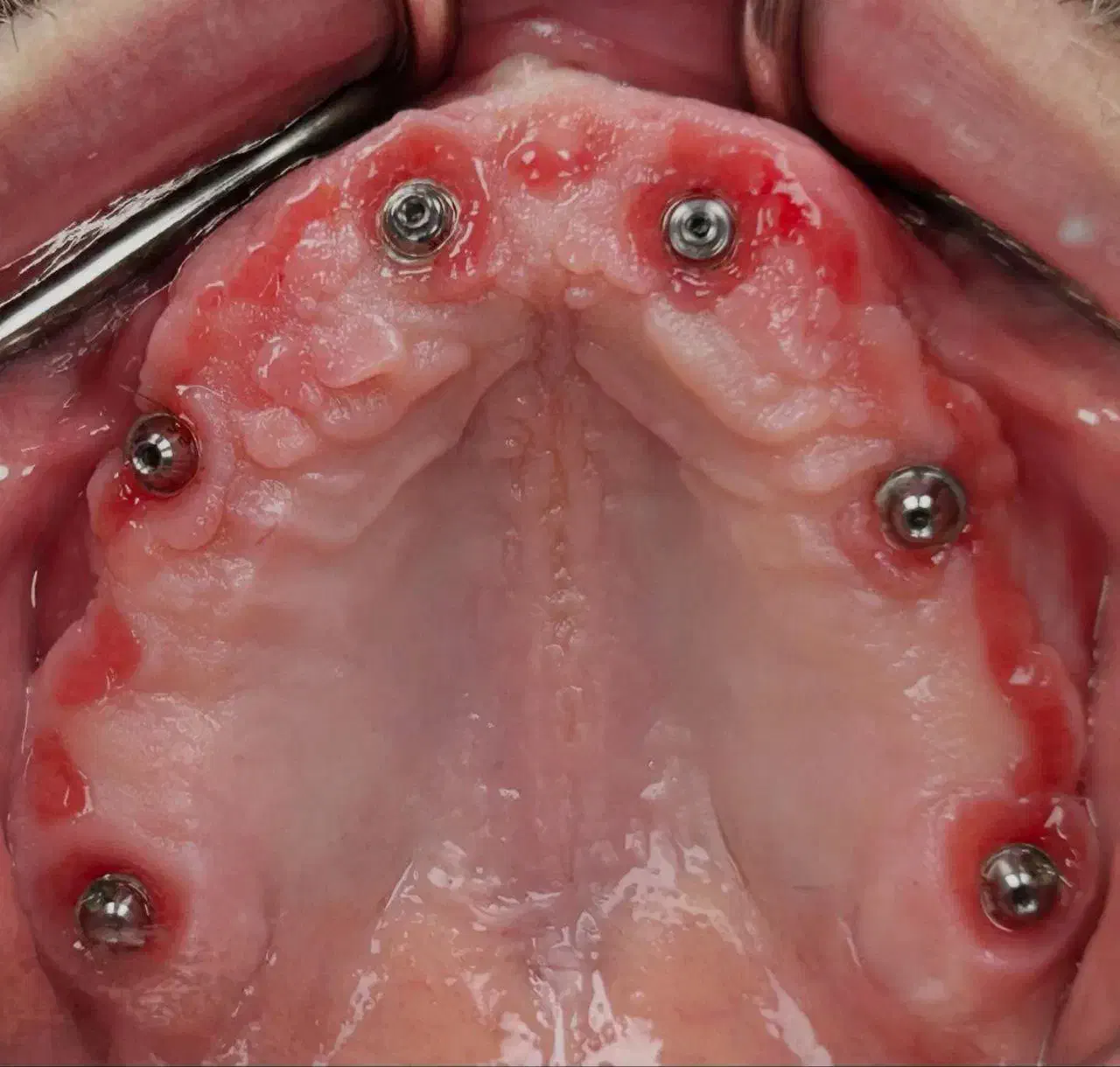 دندانپزشکی ایمپلنت دیجیتال و فوری با اقساط بلندمدت|خدمات آرایشگری و زیبایی|تبریز, |دیوار