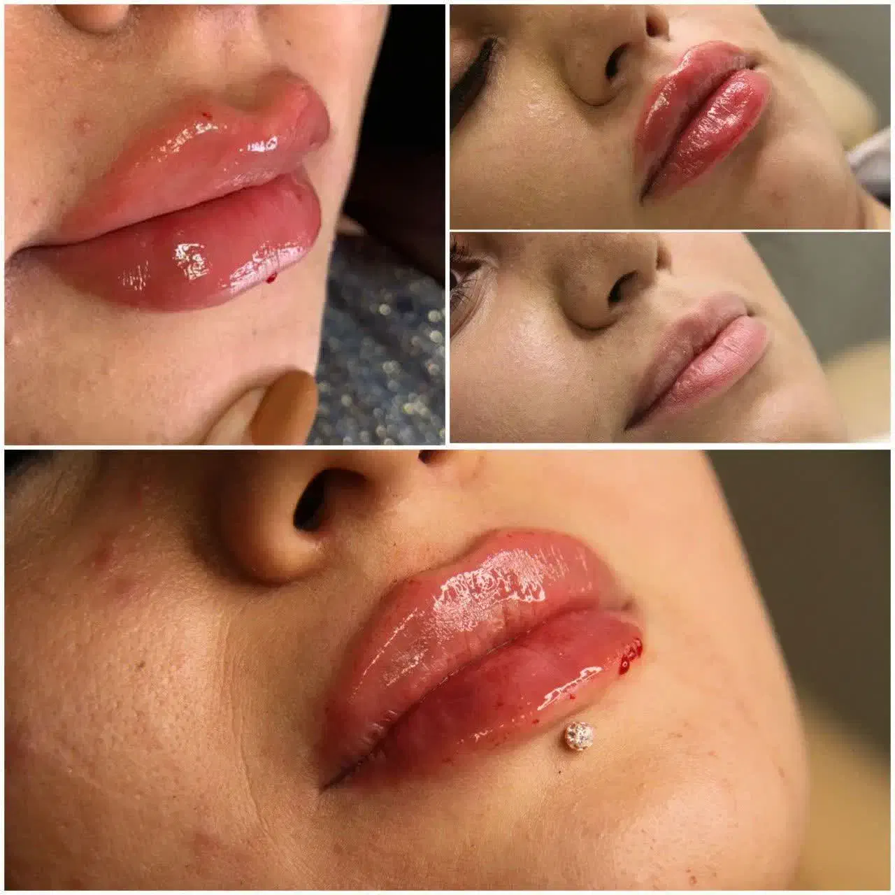 ژل بوتاکس ساکشن چربی نخ لیزر PRPجراحی زیبایی سهند|خدمات آرایشگری و زیبایی|سهند, |دیوار