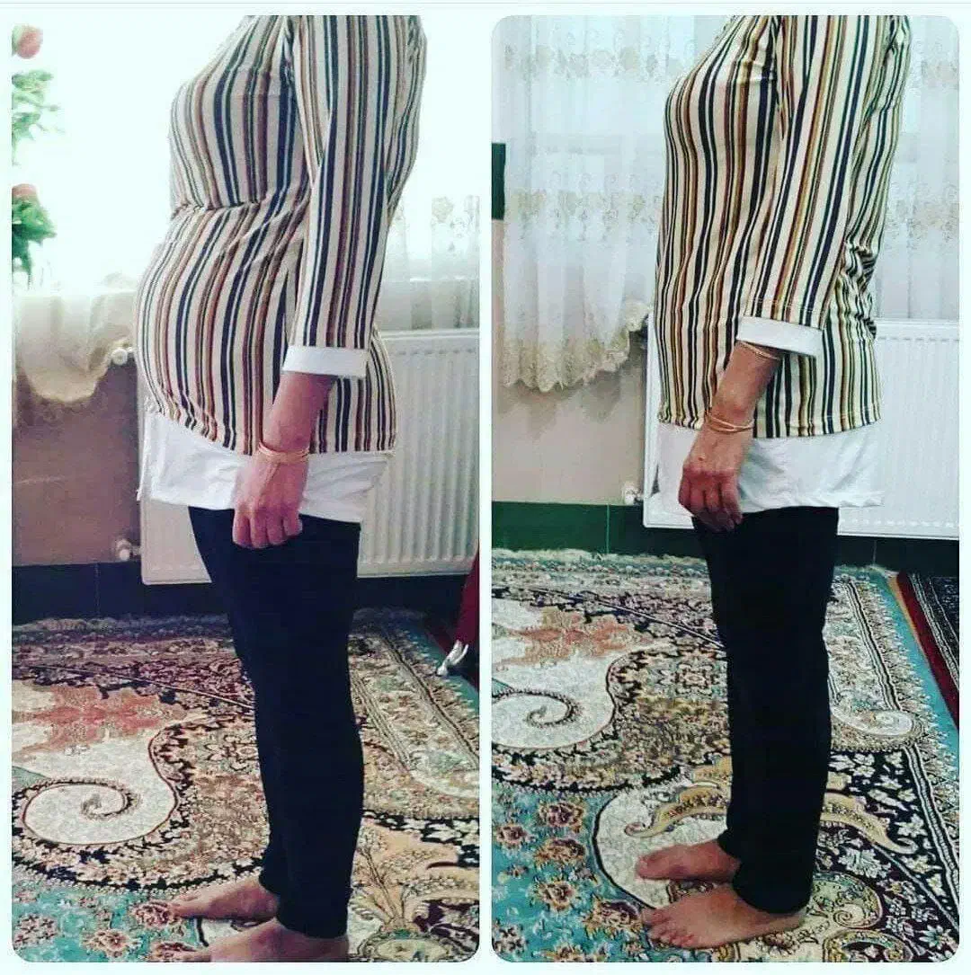 چربی سوزی شکم پهلو|آرایشی، بهداشتی، درمانی|گناباد, |دیوار