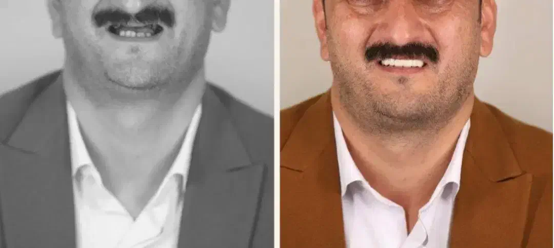 ایمپلنت|خدمات آرایشگری و زیبایی|کرج, فاز ۱ مهرشهر|دیوار