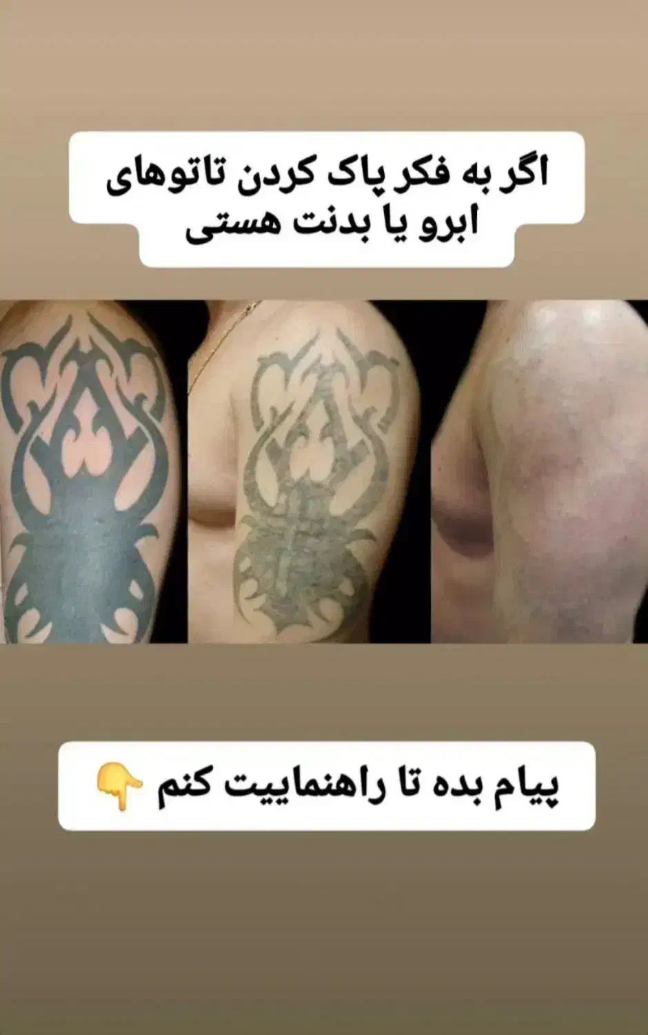 پاک کردن انواع تتو و خالکوبی بالیزر تخصصی کیوسویچ|خدمات آرایشگری و زیبایی|فولادشهر, پارک کوهستان|دیوار