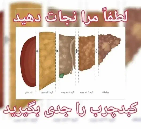 پاکسازی کبد چرب تضمینی|خدمات آرایشگری و زیبایی|گرگان, |دیوار