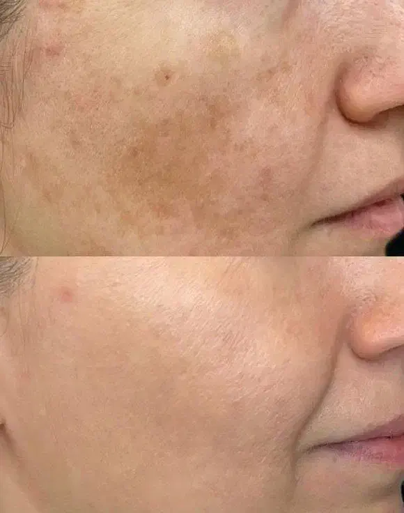 جای جوش و لک صورت و ....با ما برطرف کن|آرایشی، بهداشتی، درمانی|شیراز, دانشگاه شیراز|دیوار