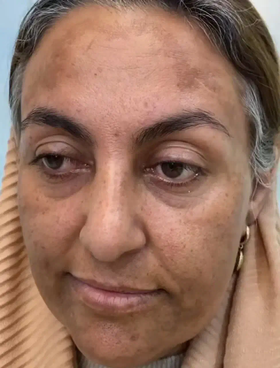 فروش کرم های ضد لک|آرایشی، بهداشتی، درمانی|قائمشهر, |دیوار