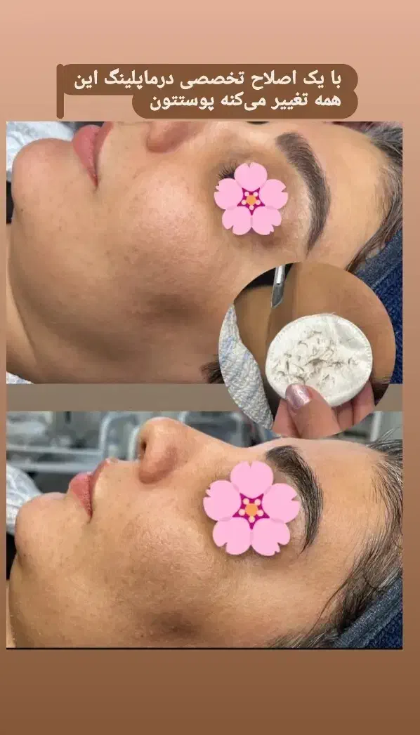 فشیال تخصصی واصلاح تخصصی درماپلینگ|خدمات آرایشگری و زیبایی|بیرجند, |دیوار