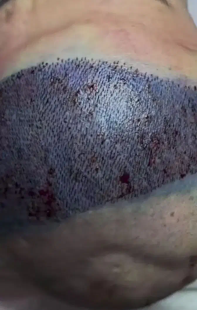 کاشت مو و ابرو|خدمات آرایشگری و زیبایی|سراب, |دیوار