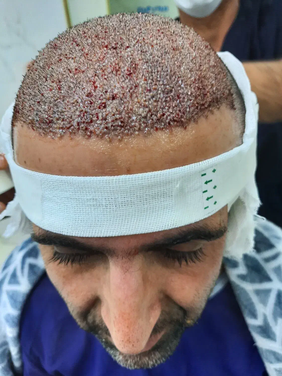 کاشت مو در کلینیک تخصصی|خدمات آرایشگری و زیبایی|شیراز, قصرالدشت|دیوار