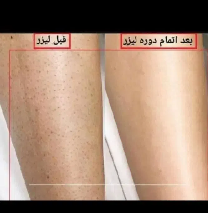 ۳۰٪ تخفیف لیزر موهای زائد /پاک کردن تتو/کربن تراپی|خدمات آرایشگری و زیبایی|بروجرد, |دیوار