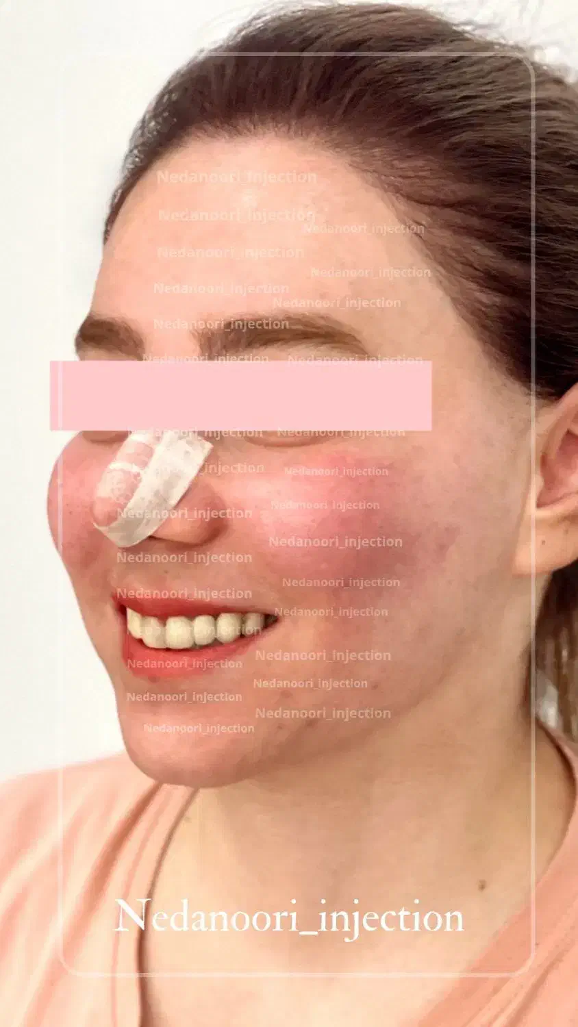 تخفیف ژل/بوتاکس/مزو/آنزیم/ساکشن غب غب|خدمات آرایشگری و زیبایی|اهواز, کیانپارس |دیوار
