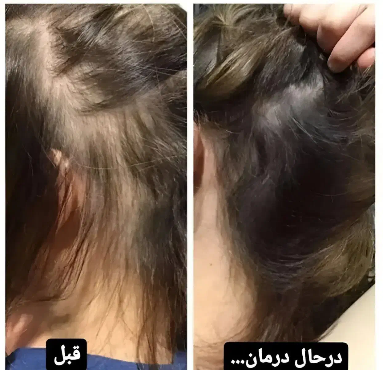 درمان ریزش مو|آرایشی، بهداشتی، درمانی|مشگین شهر, |دیوار