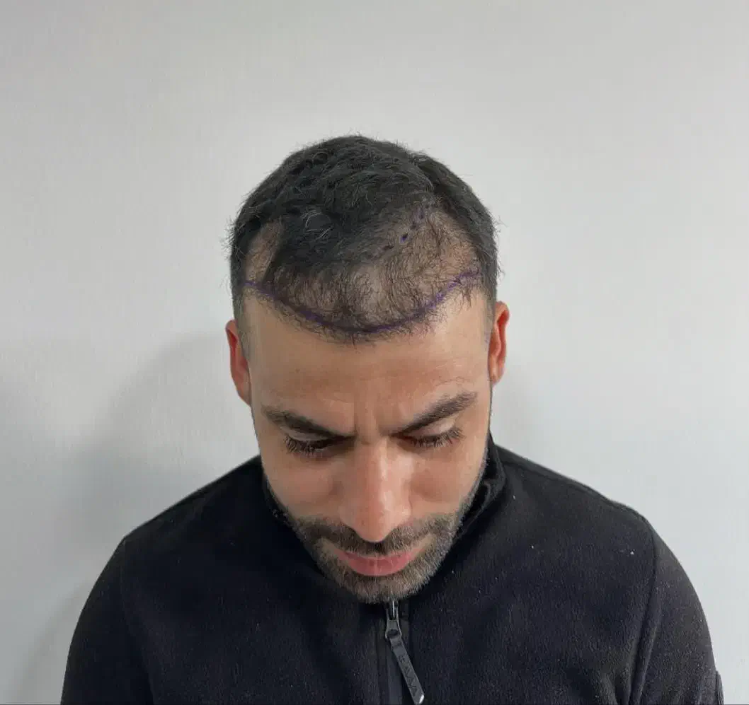 کاشت مو و ابرو|خدمات آرایشگری و زیبایی|میانه, |دیوار