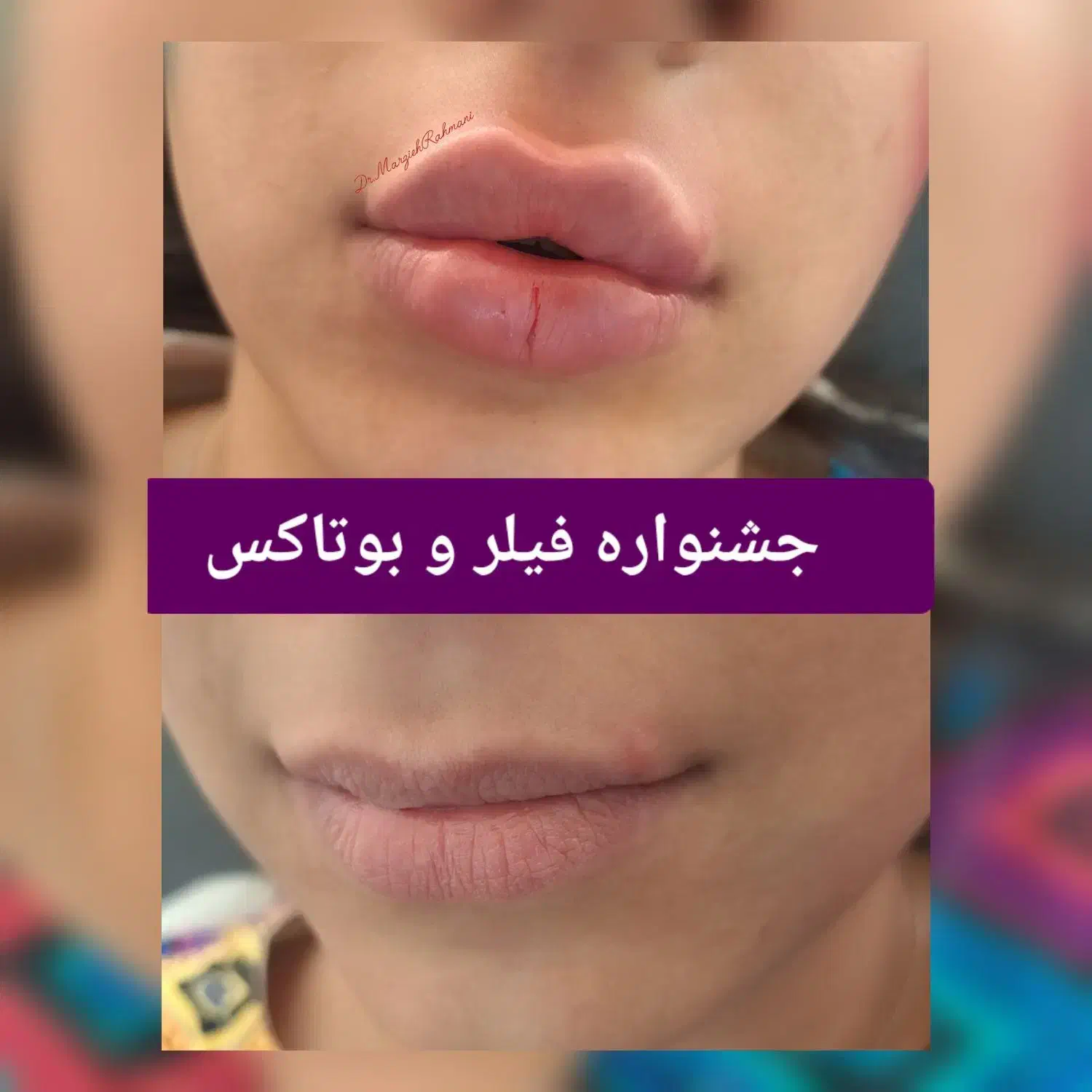 فیلر و بوتاکس|خدمات آرایشگری و زیبایی|ارومیه, |دیوار