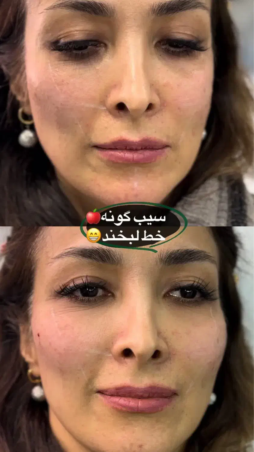 ژل لب بوتاکس آنزیم فیلر لیزر پاکسازی پوست فشیال|خدمات آرایشگری و زیبایی|کرج, گوهردشت|دیوار