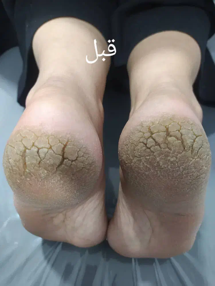 پاکسازی سازی پا با پدیکور|خدمات آرایشگری و زیبایی|نورآباد, |دیوار