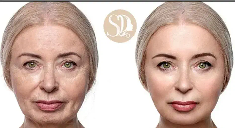 لیزر اندولیفت جهت جوانسازی در مطب متخصص پوست و مو|خدمات آرایشگری و زیبایی|جهرم, |دیوار