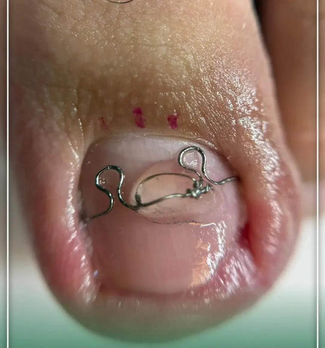 .پدولوژی ودرمان تخصصی عارضه های ناخن وپوست پا|خدمات آرایشگری و زیبایی|مرند, |دیوار