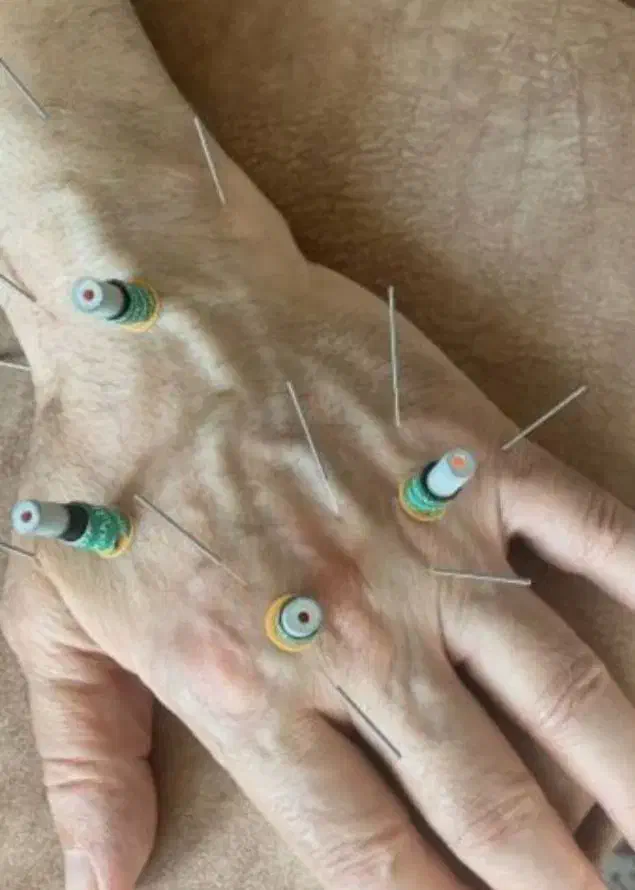 حجامت طبی سوزنی امبدینگ زالودرمانی زگیل تناسلیhpv|خدمات آرایشگری و زیبایی|اصفهان, بهارستان (مخابرات)|دیوار