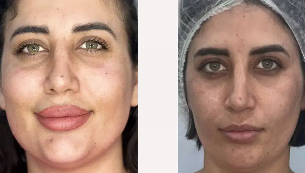 مدل فیلر صورت در کلینیک نوا|خدمات آرایشگری و زیبایی|شیراز, ستارخان|دیوار