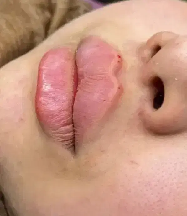 تزریق ژل|خدمات آرایشگری و زیبایی|خرمشهر, |دیوار