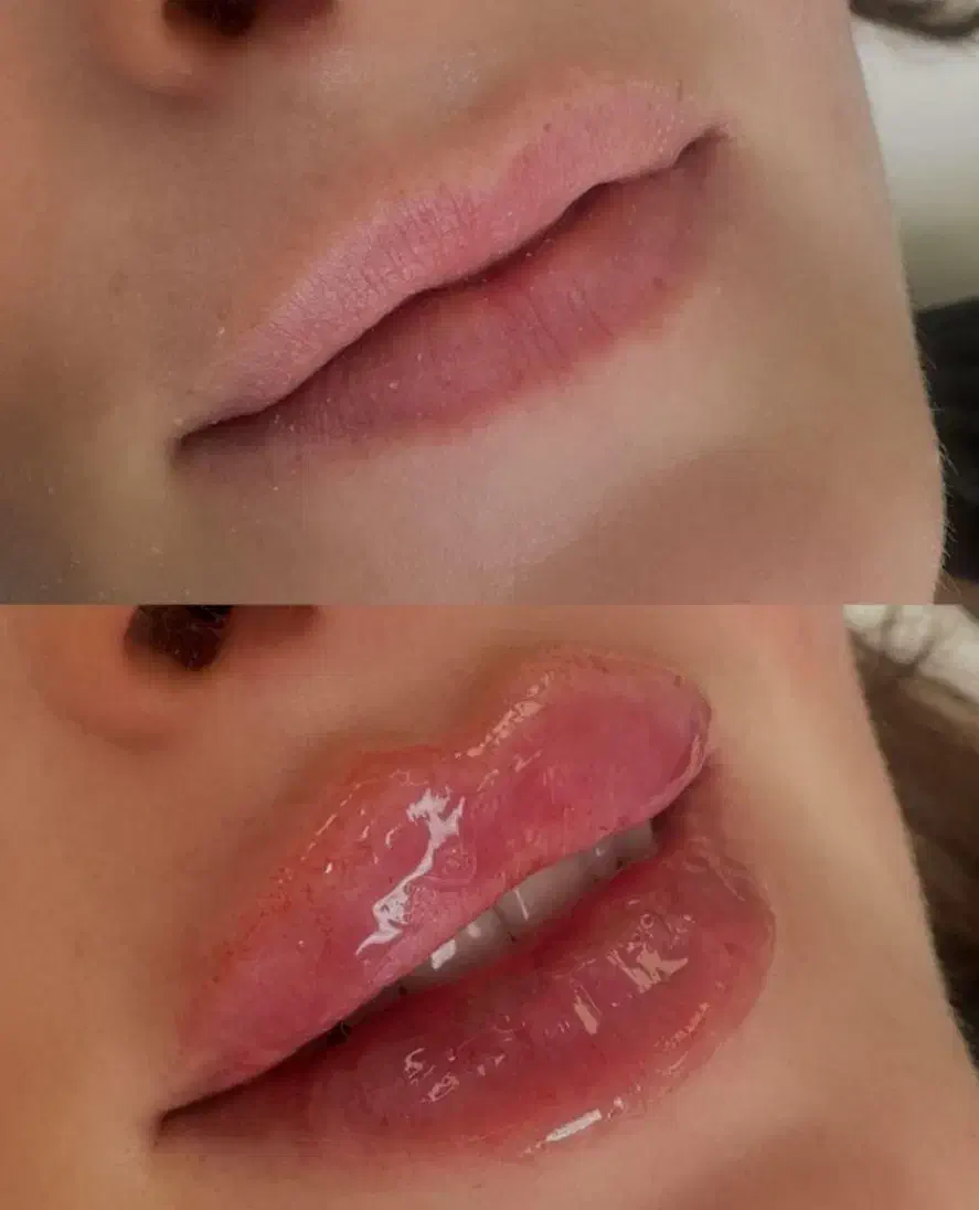 تخفیف فوق العاده خدمات ژل و بوتاکس در مطب|خدمات آرایشگری و زیبایی|شاهینشهر, بوستان حافظ|دیوار