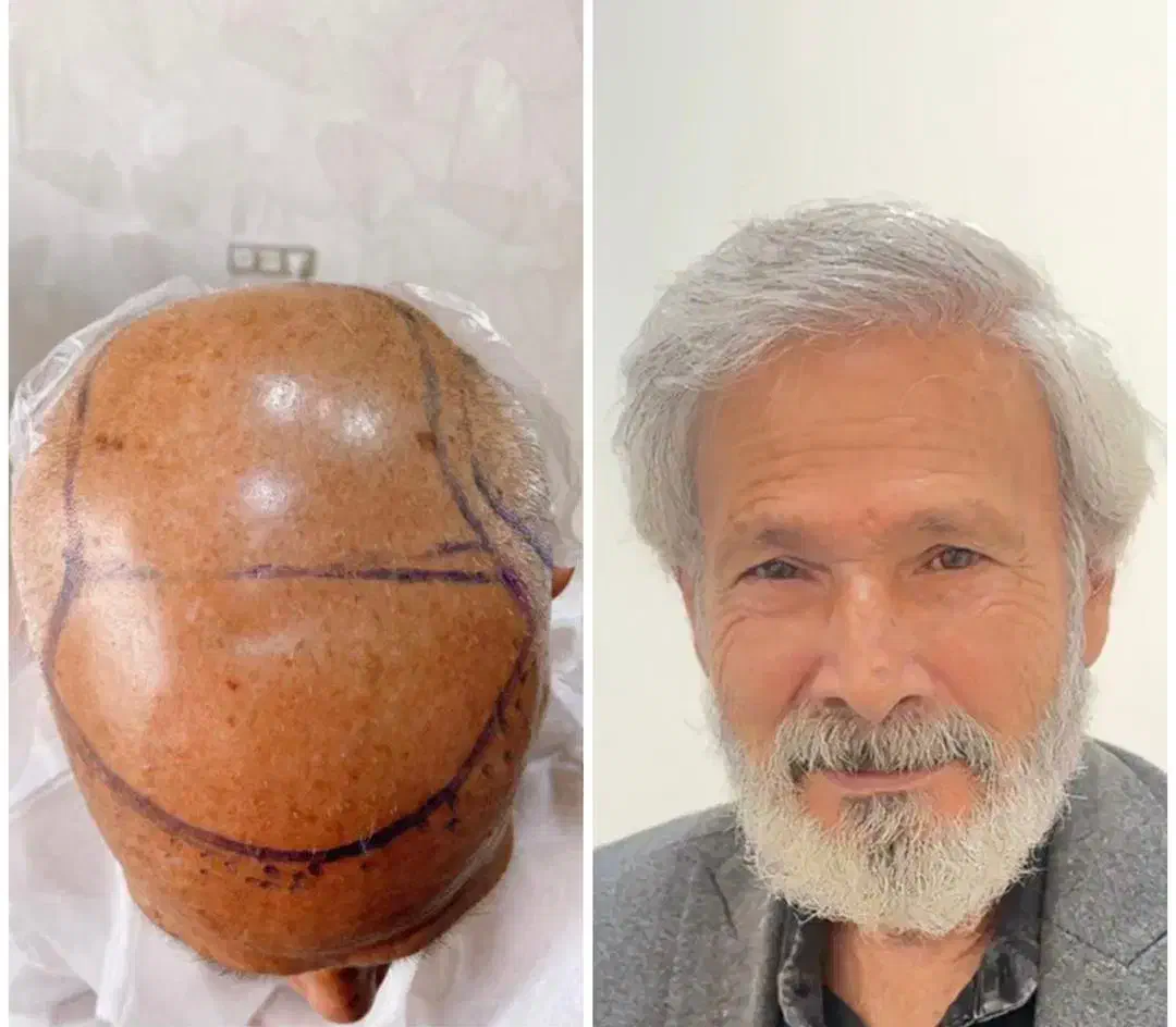 کاشت مو میکرو گرافت شیرازی(۱۰۰ درصد تضمینی)شرایطی|خدمات آرایشگری و زیبایی|یزد, |دیوار