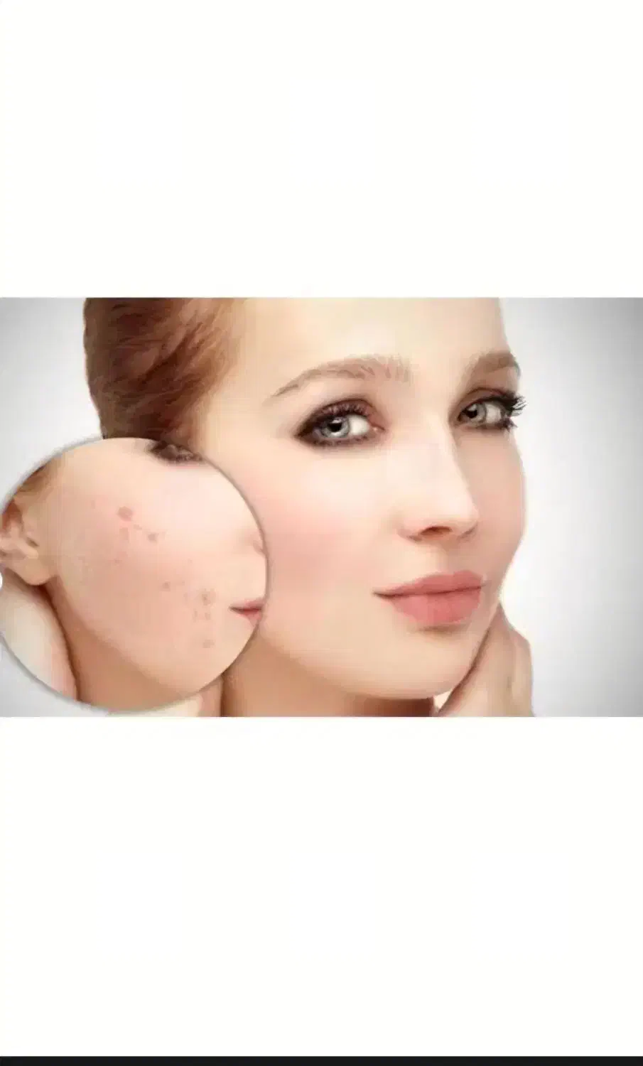 توجه توجه برداشتن خال،کک به صورت کاملا تضمینی|خدمات آرایشگری و زیبایی|تاکستان, |دیوار