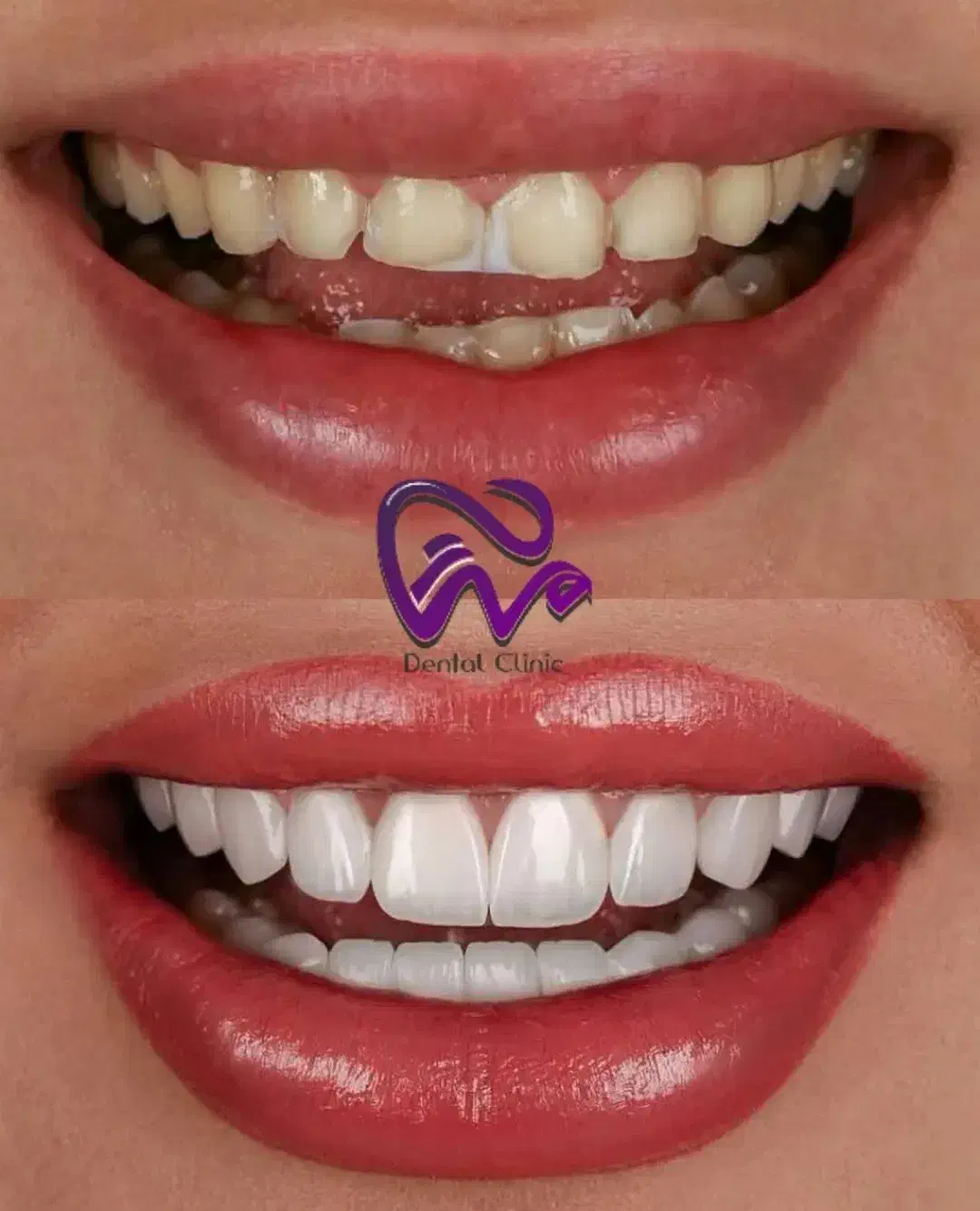 کامپوزیت دندان لبه شیشه ای فکی ۱۰ با اقساط بلندمدت|خدمات آرایشگری و زیبایی|تهران, تجریش|دیوار