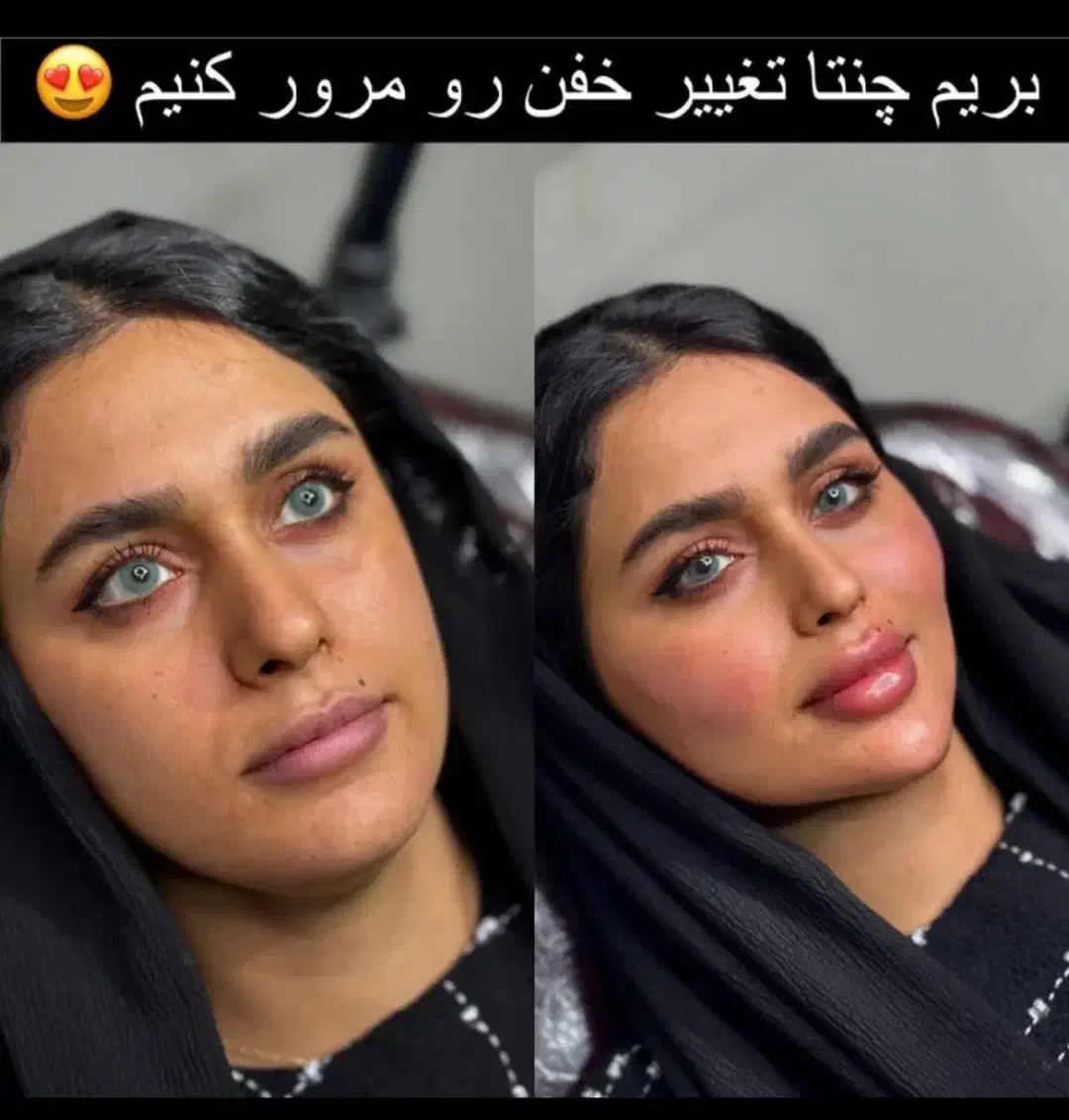 تخفیف جشنواره تزریق ژل و فیلر لب و فول فیس در مطب|خدمات آرایشگری و زیبایی|اصفهان, ملکشهر|دیوار