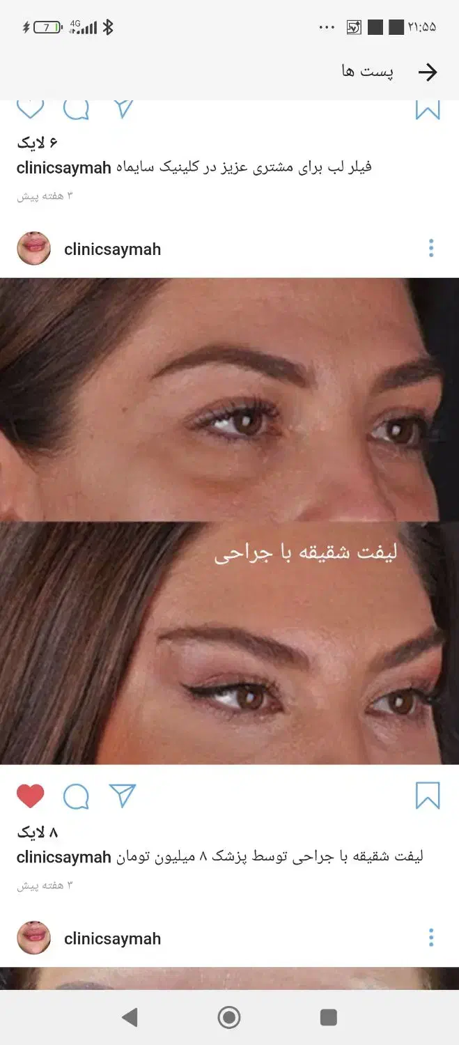 تزریق ژل بوتاکس نخ ...توسط پزشک در کلینیک سایماه|خدمات آرایشگری و زیبایی|کرمان, |دیوار