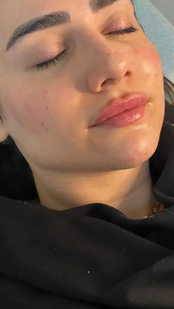 بوتاکس،فیلر توسط پزشک پوست و زیبایی(تخفیف استثنایی|خدمات آرایشگری و زیبایی|تهران, دروس|دیوار