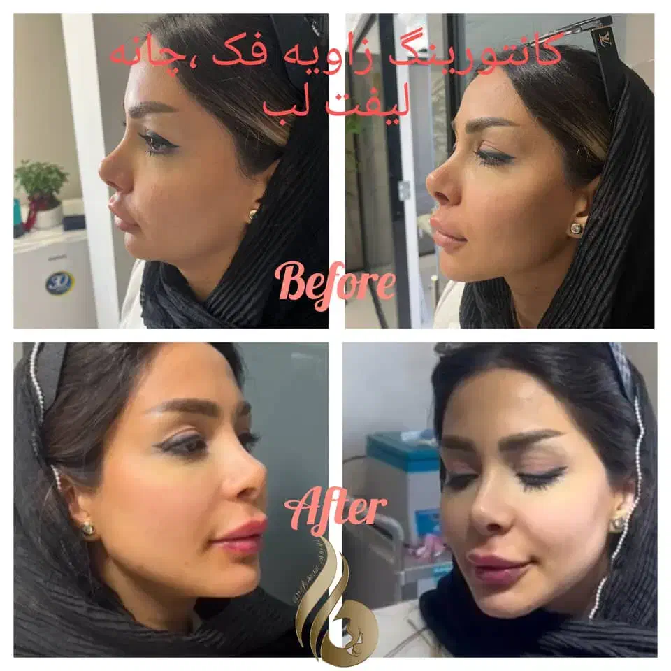 متقاضی مدل فیلر بوتاکس لیفت نخ|خدمات آرایشگری و زیبایی|تهران, دروس|دیوار