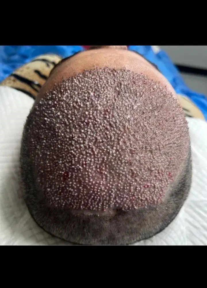 کاشت مو|خدمات آرایشگری و زیبایی|اهواز, نادری|دیوار