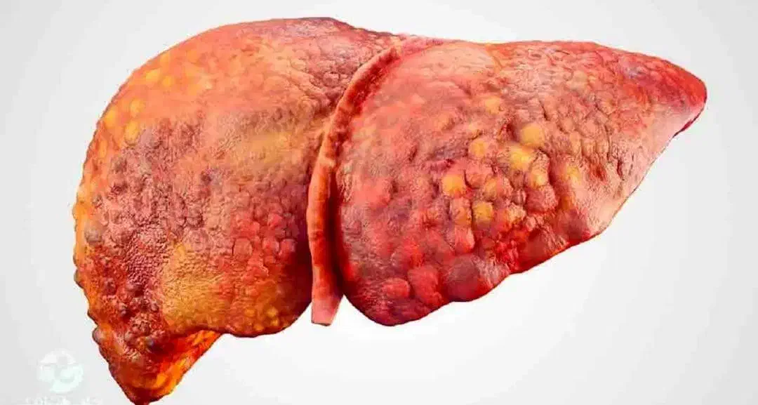 پاکسازی کبد در 21 روز|آرایشی، بهداشتی، درمانی|رامیان, |دیوار