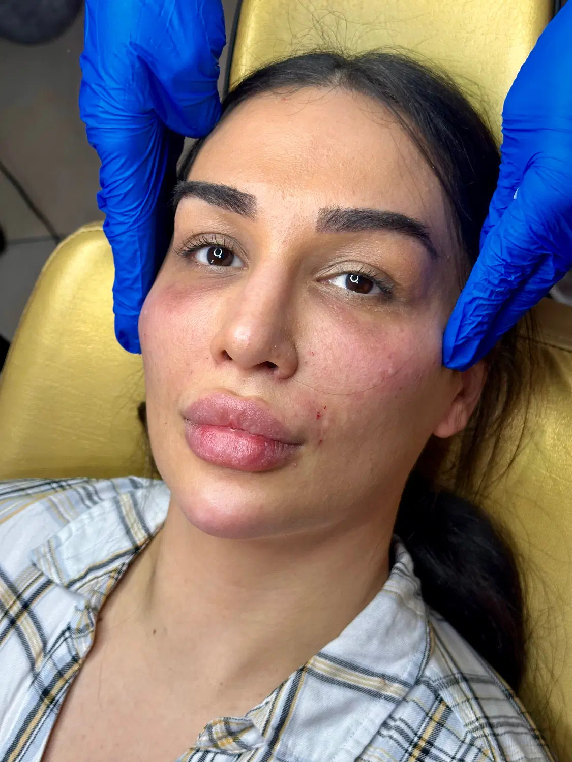فیلر بینی ژل لب تکنیک M تخصصی تزریق فول فیس نچرال|خدمات زیبایی و سلامت|تهران, الهیه|دیوار