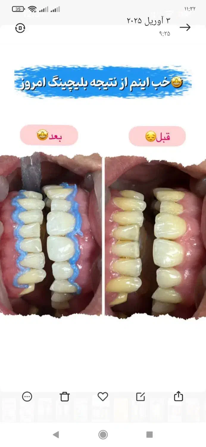 پاکسازی حرفه ای دندان|آرایشی، بهداشتی، درمانی|یزد, |دیوار