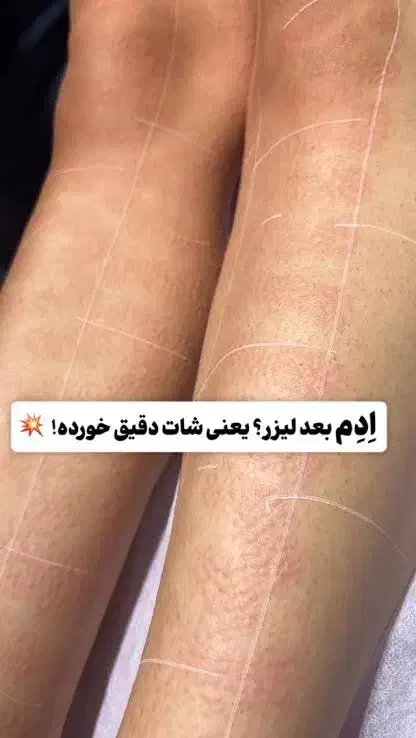 لیزر کندلا با قیمت دوسال پیش|خدمات آرایشگری و زیبایی|اصفهان, بهار آزادی|دیوار