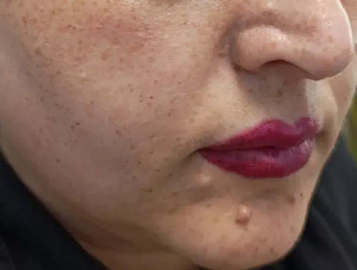 برداشتن انواع خال و لک و کک و مک|خدمات آرایشگری و زیبایی|نورآباد, |دیوار