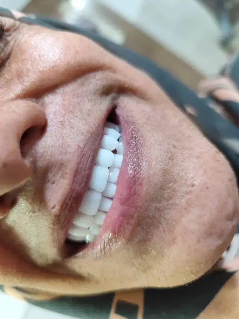 دندان مصنوعی وارداتی هر فک ۵ تومان|خدمات آرایشگری و زیبایی|کرج, کمالشهر|دیوار