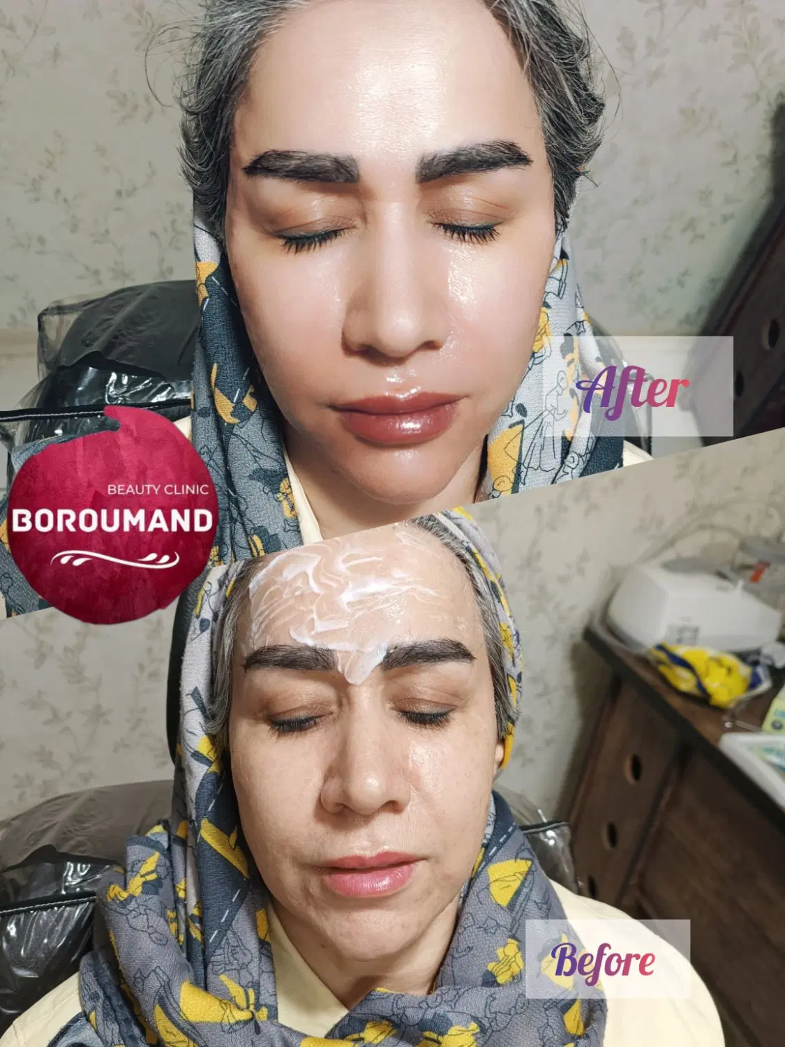 جشنواره ژل لب/فیلرلب/بوتاکس/آنزیم/هایفو توسط پزشک|خدمات زیبایی و سلامت|مشهد, هدایت|دیوار