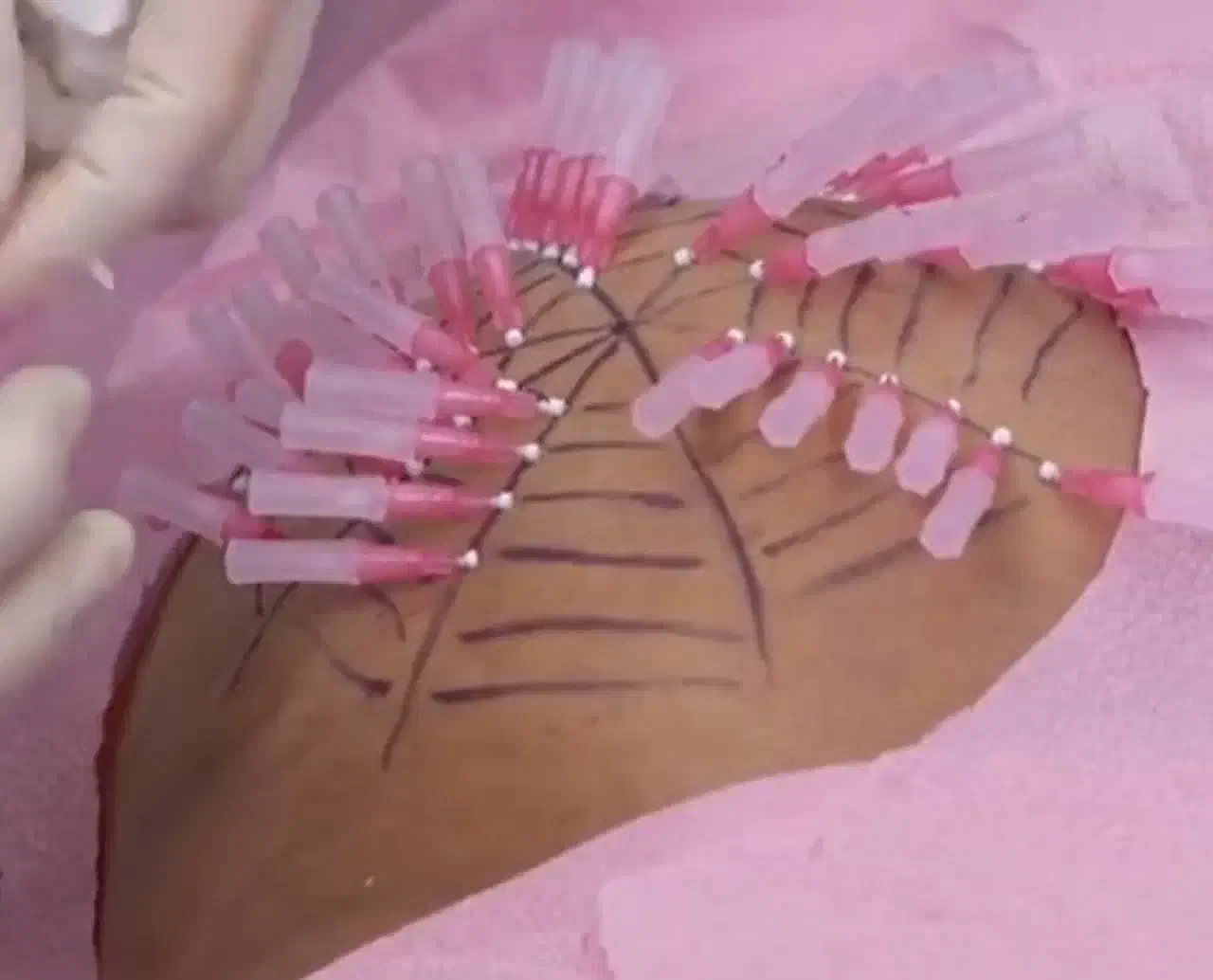 رفع معایب و عوارض فیلر و چربی|خدمات آرایشگری و زیبایی|تهران, دروس|دیوار