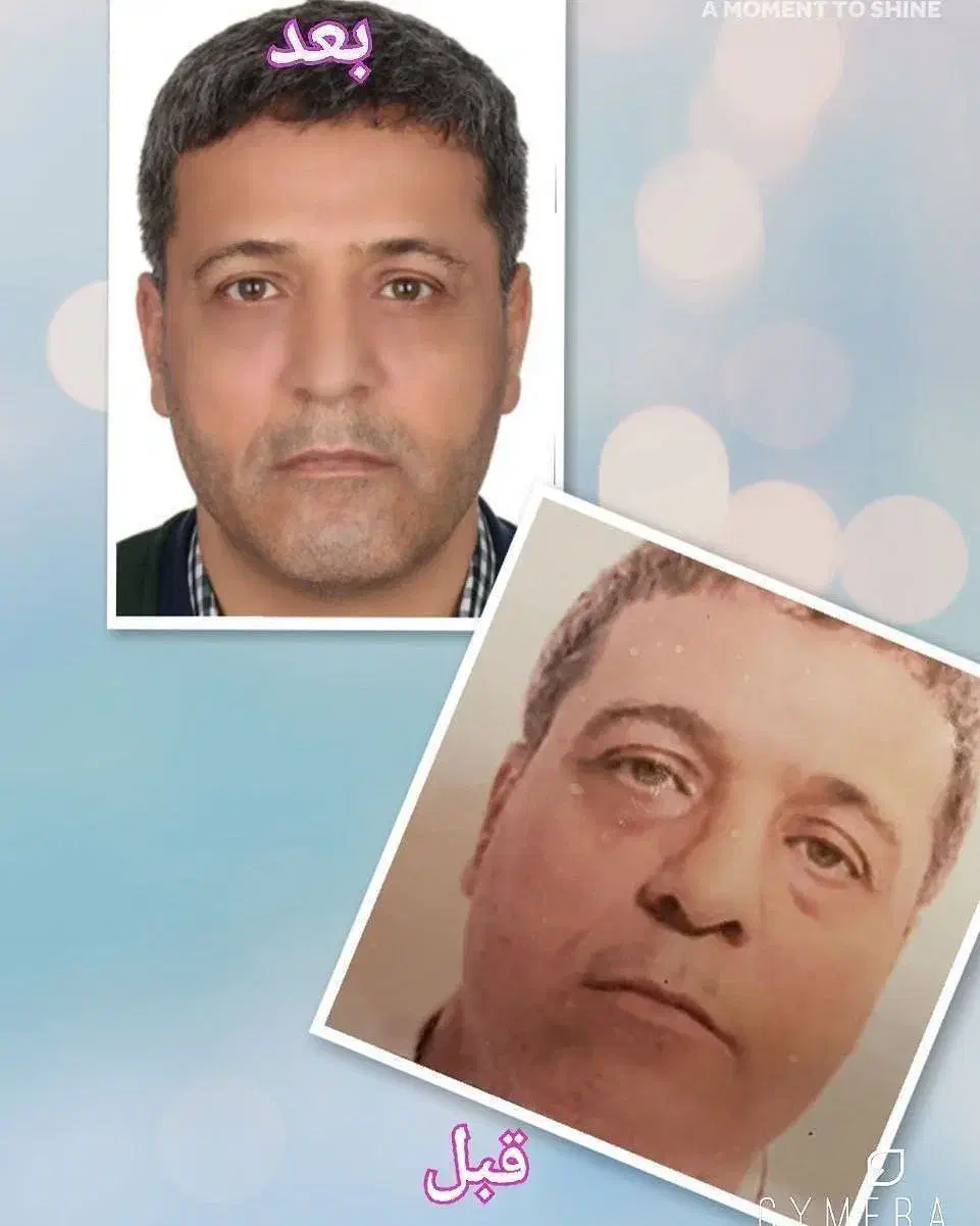 تنهامرکزلیفت صورت،بابیشترین تعدادنخاردارونخبدونخار|خدمات آرایشگری و زیبایی|مشهد, نیروی هوایی|دیوار