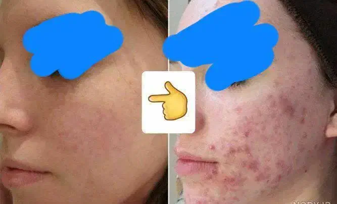 مشکلات پوستیی پسوریازیس لک و...تضمینی|آرایشی، بهداشتی، درمانی|اردبیل, |دیوار