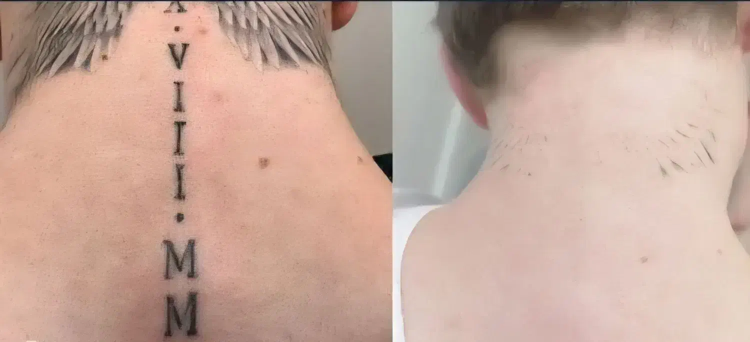 قویترین پاکسازی تاتو.درمان لک.ماه گرفتگی.کربنتراپی|خدمات آرایشگری و زیبایی|یاسوج, |دیوار