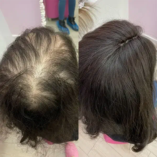 میکرو اسکالپ موی سر ،ریش، ابرو( در محل)|خدمات آرایشگری و زیبایی|تهران, سعادتآباد|دیوار