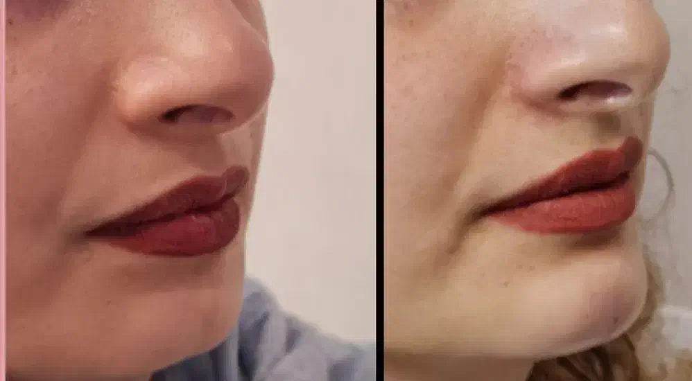 مدل جهت ژل وبوتاکس وانزیم|خدمات آرایشگری و زیبایی|نهاوند, |دیوار