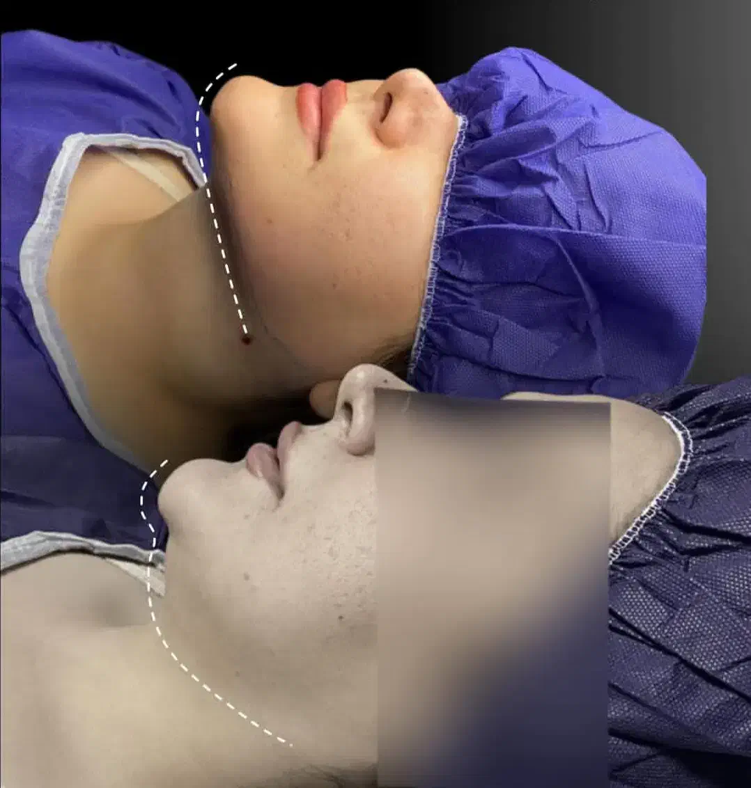 ساکشن غبغب|خدمات آرایشگری و زیبایی|یاسوج, |دیوار