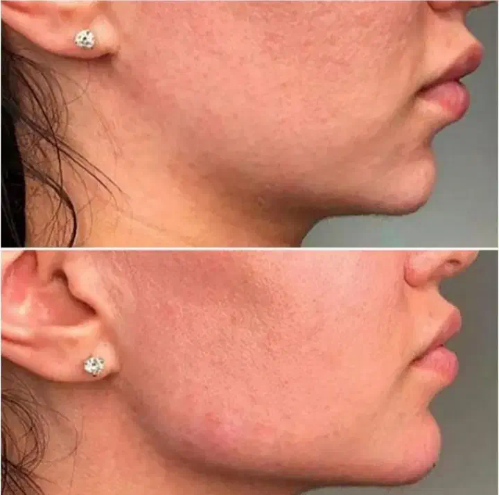 تزریق ژل بوتاکس لیفت مادلینگ و کانتورینگ کلینیک|خدمات آرایشگری و زیبایی|بندرعباس, |دیوار