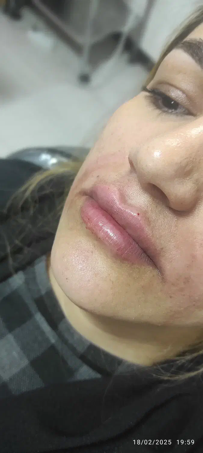تزریق ژل و بوتاکس|خدمات آرایشگری و زیبایی|اصفهان, گلزار|دیوار