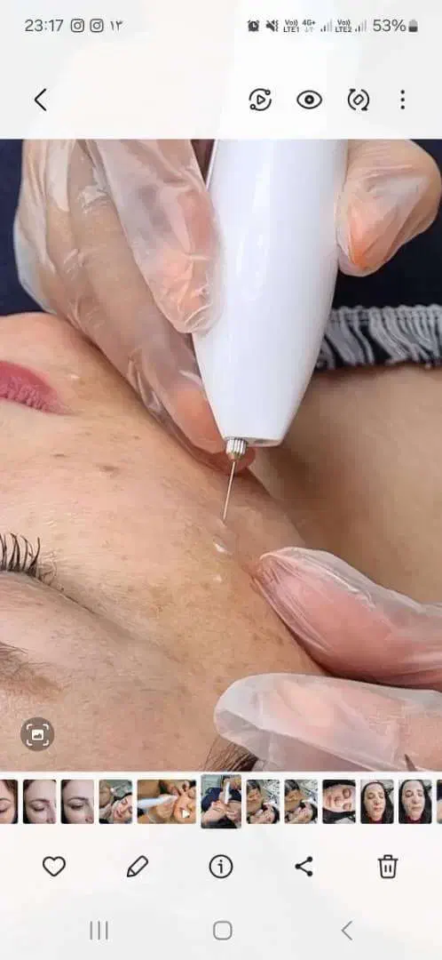خدمات ریموو تتو صورت وجوانسازی صورت|خدمات آرایشگری و زیبایی|اصفهان, شهرک ولیعصر|دیوار