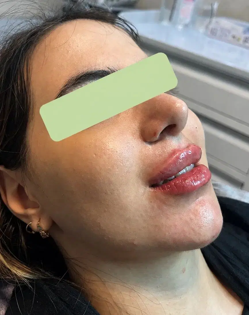 فیلرلب/ژل لب/توسط پزشک/انواع مدل ژل لب|خدمات زیبایی و سلامت|مشهد, عامل|دیوار